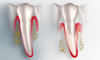Prophylaxe und professionelle Zahnreinigung in der Zahnarzt Praixs sind die beste Vorbeugung